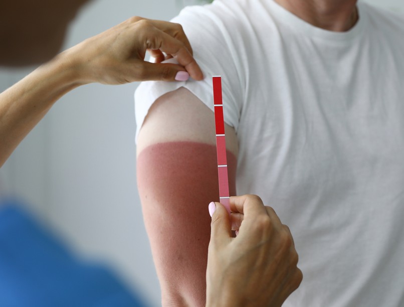 napégés, leégés, melanóma, leégés kezelése,  UV-sugárzás, Fitzpatrick-skála, hólyagok