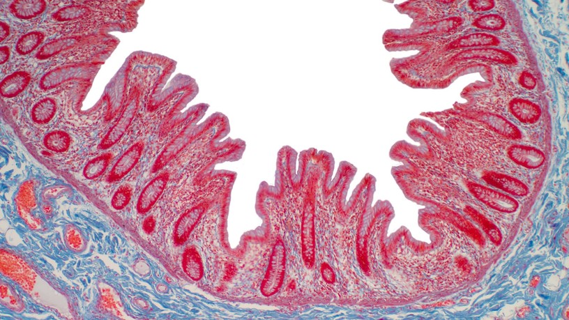 fekélyes vastagbélgyulladás típusa Mikroszkópos colitis
