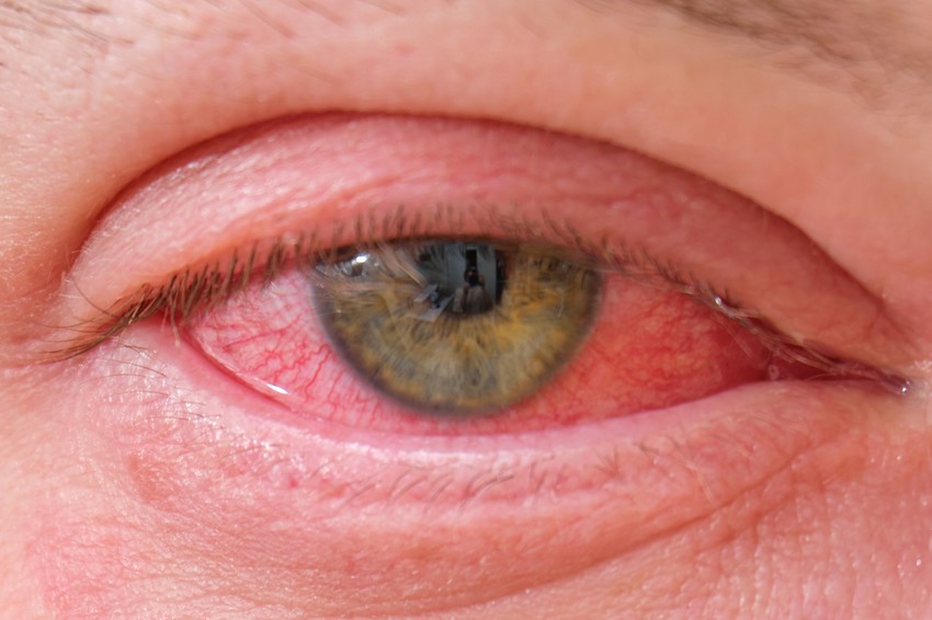 A kötőhártya-gyulladás egyik leggyakoribb és legjellemzőbb tünete a vörösség, ami a szemekfehérjét is elszínezi, a szemek körüli terület pirosas vagy rózsaszín árnyalatúvá válhat, a szem viszket, ég, és váladékozni kezd.