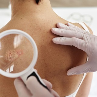 Áttörés a pikkelysömör kezelésében: jönnek a szájon át szedhető célzott terápiák című cikk nyitóképe