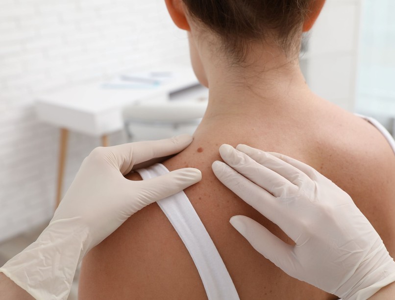 műtéti beavatkozás eltávolítható anyajegy mikor