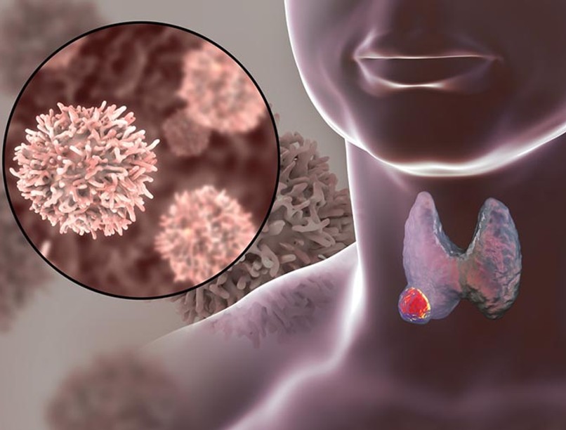 pajzsmirigy_tevhitek