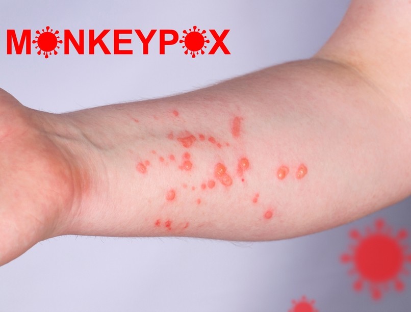 majomhimlő, vírus, bőrkiütés, kiütés, majomhimlő tünetei, fekete himlő, 