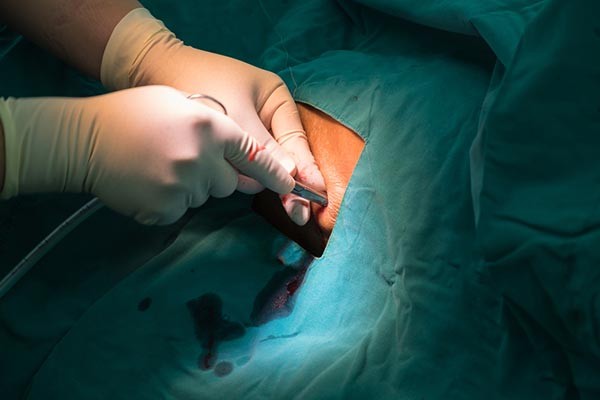 Feleslegessé válhatnak a beültethető defibrillátorok