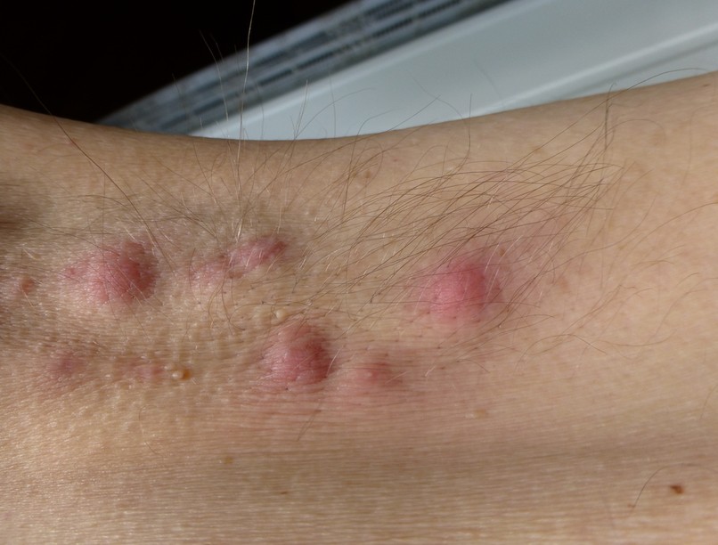 krónikus verejtékmirigy-gyulladás, kiütések, tályogok, HS