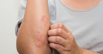  Ezt jelzi, ha érme alakú, viszkető foltok jönnek ki a kezén, lábán 