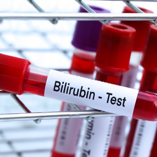 Mit jelent a bilirubin érték a laborleleten? című cikk nyitóképe