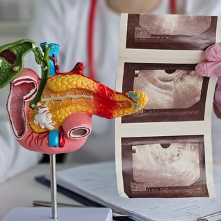 Új remény a hasnyálmirigyrák ellen: D-vitaminnal bontják le a daganat védőpajzsát című cikk nyitóképe