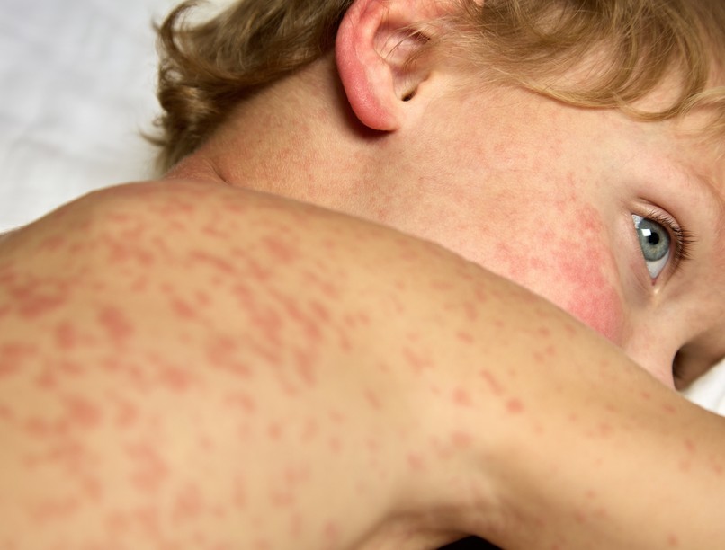 Rubeola tünet vizsgálat kezelés