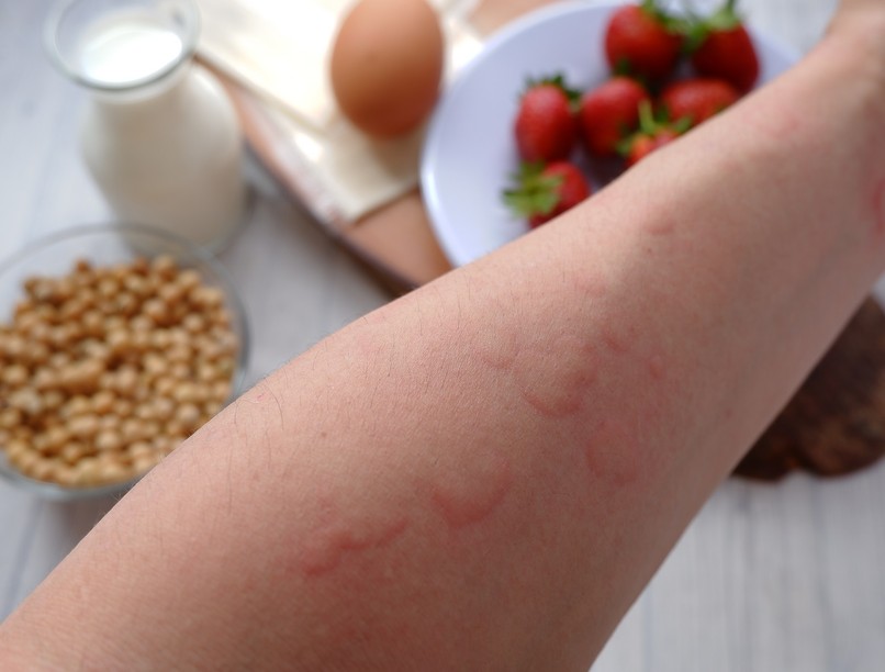 csalankiutes-borbetegsegek-allergia-dieta-autoimmun-betegseg-borbetegseg