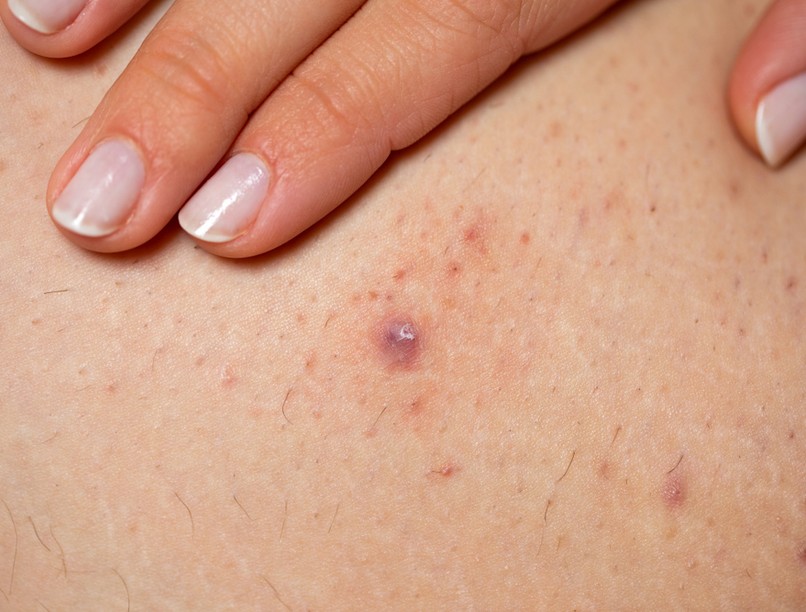 szőrtüszőgyulladás, szőrtüsző, gyulladás, follikulitisz, pattanás, szőrtelenítés, borotválkozás, epilálás, gyantázás, befelé növő szőr, hegesedés, bőrápolás, kelés