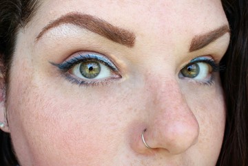 Így néz ki a bőr a szem körül, ha magas a koleszterinszint