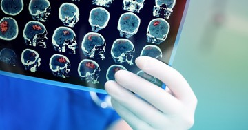  Ilyen módszerekkel ösztönözhető gyógyulásra stroke után az agy 