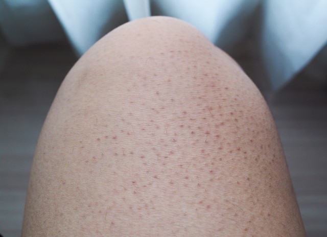 Csirkebőr, grízes bőr: a keratosis pilaris oka, tünetei és kezelése