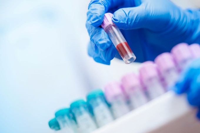 Ez a teszt sokkal többet árul el a szívéről, mint a „rossz” koleszterin szintje című cikk nyitóképe