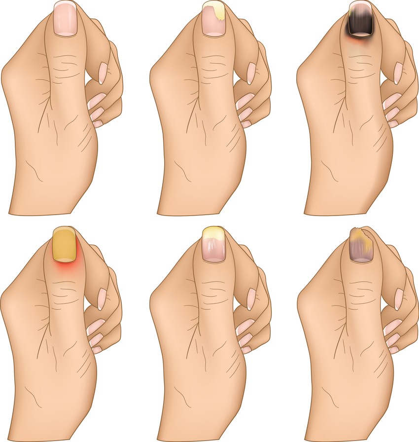 A kellemetlen tünetek ellenére nem kell kétségbe esnünk, ha körömágy-gyulladásra gyanakszunk, mivel a problémát – főleg, ha korán felismerjük ­– vény nélkül kapható készítményekkel, otthon is eredményesen kezelhetjük.