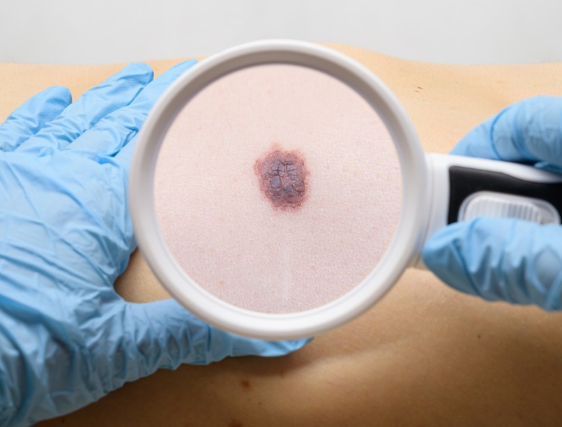 Melanoma, bőrrák, tünet