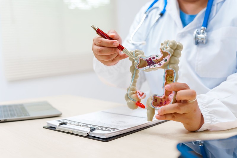 Műtét, kemoterápia vagy célzott kezelés? Ez történik a vastagbélrák egyes stádiumaiban