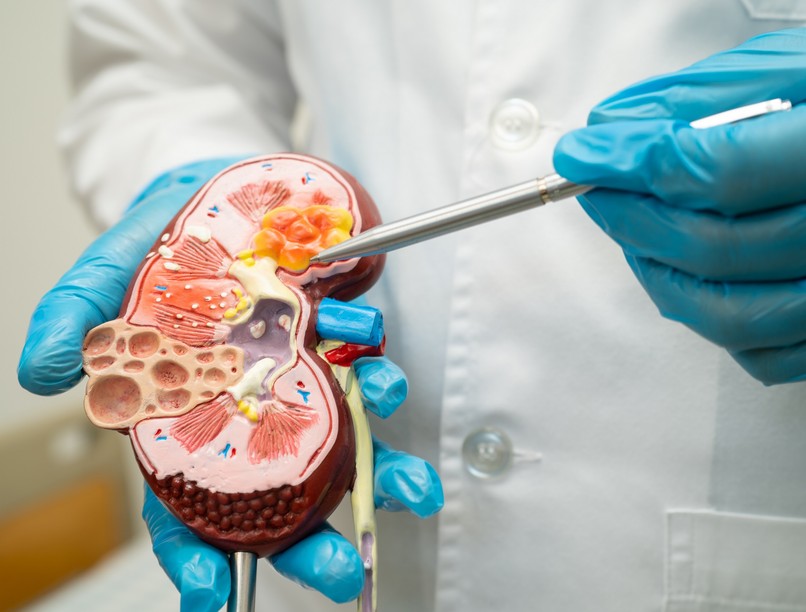 mitől alakul ki a vesekő