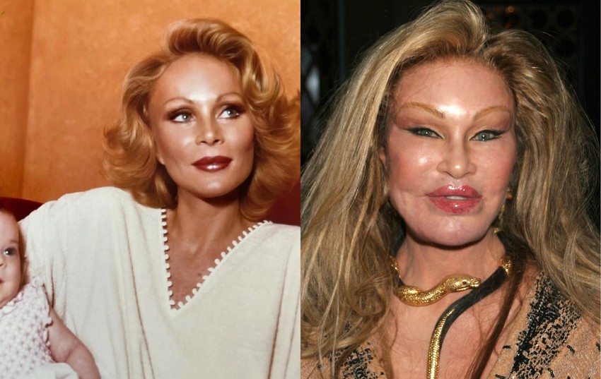 Jocelyn Wildenstein intő példa volt a szélsőséges plasztikai sebészetre – de a Z generáció nem hallgat rá.