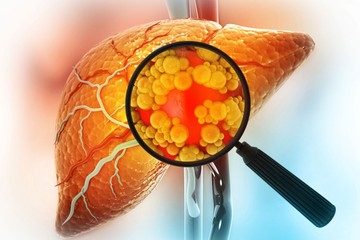 Erre a 6 dologra figyeljen, ha zsírmája van, hogy ne legyen még nagyobb baj!