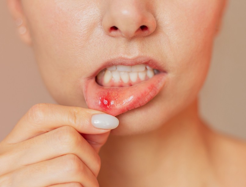 afta migrén szorongás oka glutén gluténérzékenység