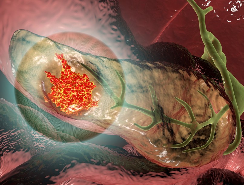 hasnyálmirigyrák, kimutatása széklet vizsgálat