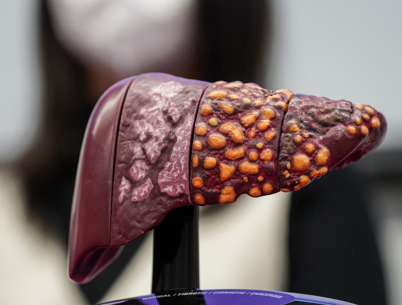 májrák májáttét mit kell tudni róla