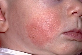 Ekcéma csecsemőkorban