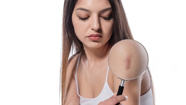 Orvosi tetoválás: így tüntetik el a heget vele című cikk nyitóképe