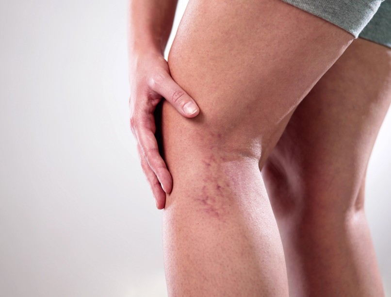 fekély, visszértágulat kezelés