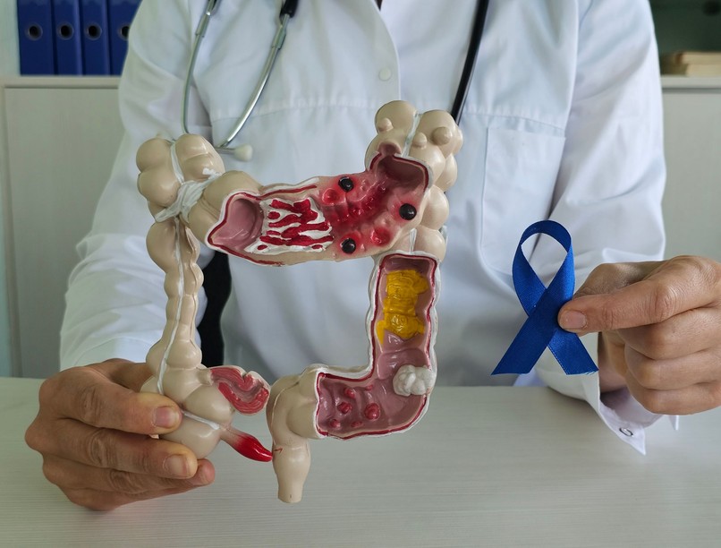 vastagbélrák kiújulás ellen kutatás mozgás