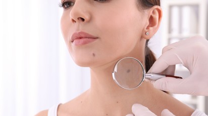 Bélbaktériumokkal meghatározható a bőrrák kockázata – de van egy bökkenő című cikk nyitóképe