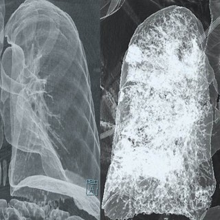 Mi a tüdő CT és mit mutat ki? című cikk nyitóképe