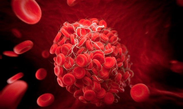 Valós veszélyek: a vénás trombózis