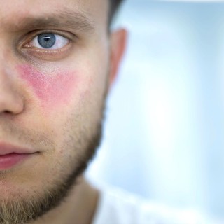 A lupus első jelei: ezeket a tüneteket sokan hónapokig figyelmen kívül hagyják című cikk nyitóképe