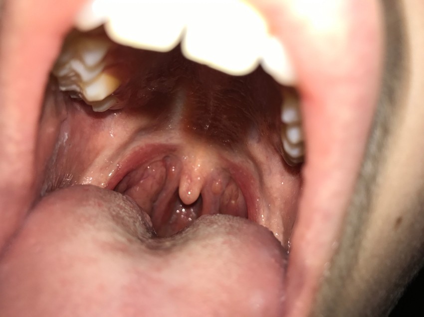 A gyógyulási folyamat az esetek egy részében akár fél évig vagy még tovább is elhúzódhat.