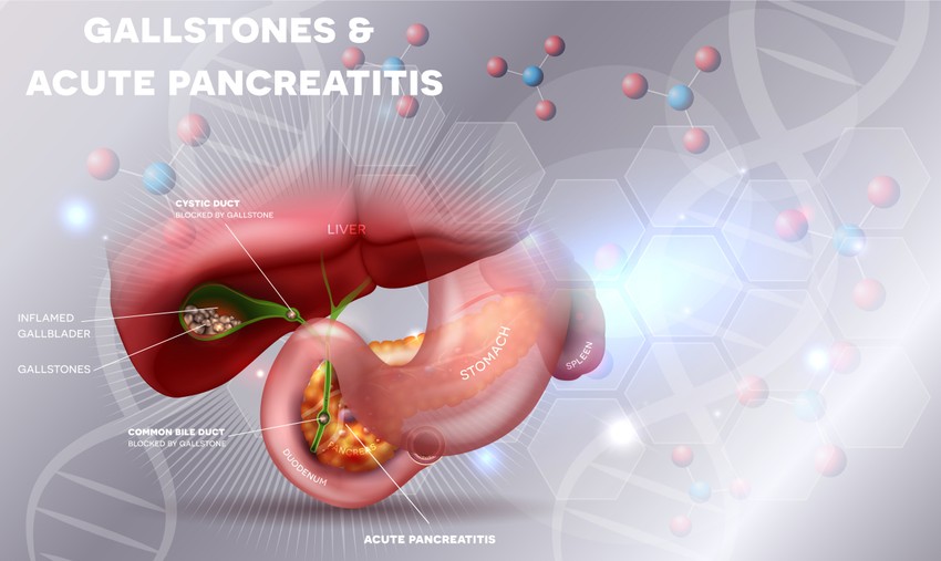 Az epekő az epehólyagban kialakuló szilárd képződmény. A legtöbb esetben az epekövesség nem jár együtt sem szabad szemmel is látható tünetekkel, elváltozásokkal, sem pedig fájdalommal vagy működési zavarokkal. Az epekő azonban időnként elzárhatja az epevezetéket, mely erős görcsöket, hányingert, hányást okozhat.