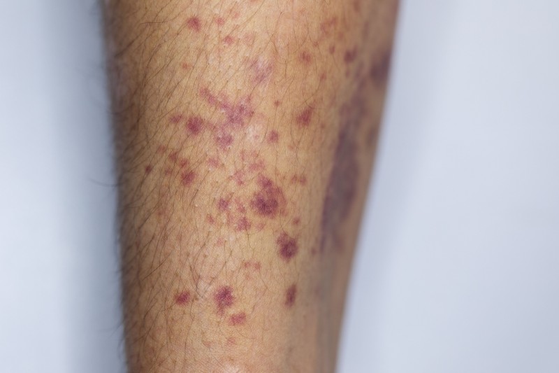 Gyanús foltok, pöttyök a lábszáron: sokan ekcémának hiszik ezt a súlyos betegséget