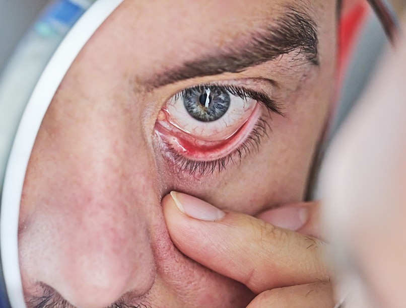 szemszárazság ellen bevált otthoni módszer