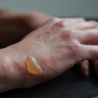 Mi a vízhólyag? című cikk nyitóképe