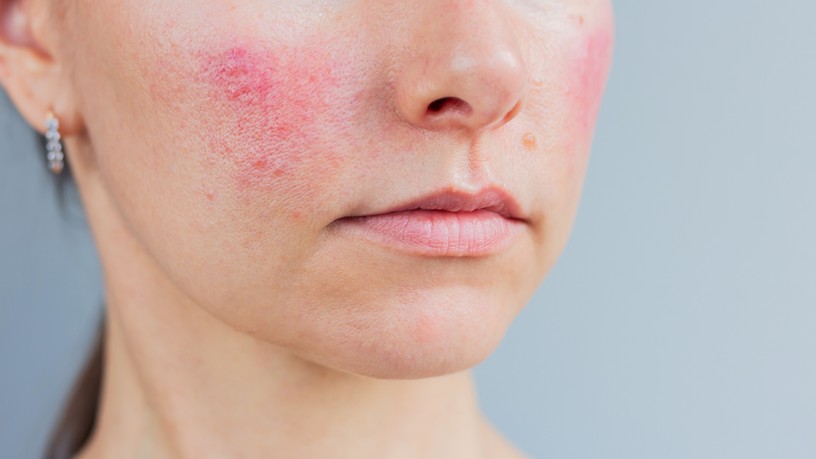 rosacea-arcpir-okok-kuperozis-kezeles