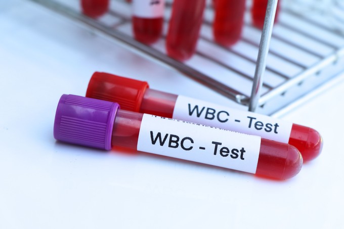 Akár leukémiára is utalhat az, ha magas a leukocyta-száma című cikk nyitóképe