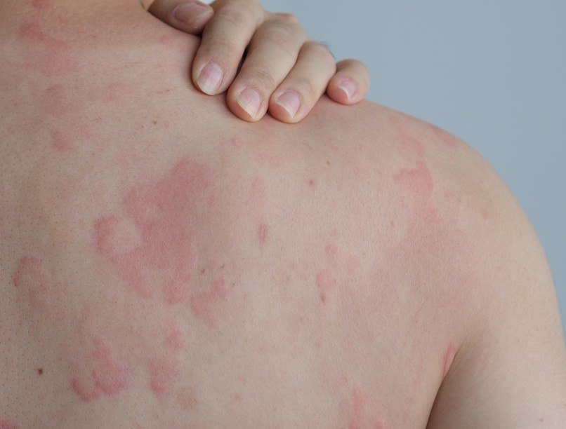 bőr kiütés viszket oka miért ellen