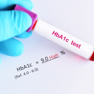 Mit jelent, ha magas a HbA1c érték a leleten? című cikk nyitóképe