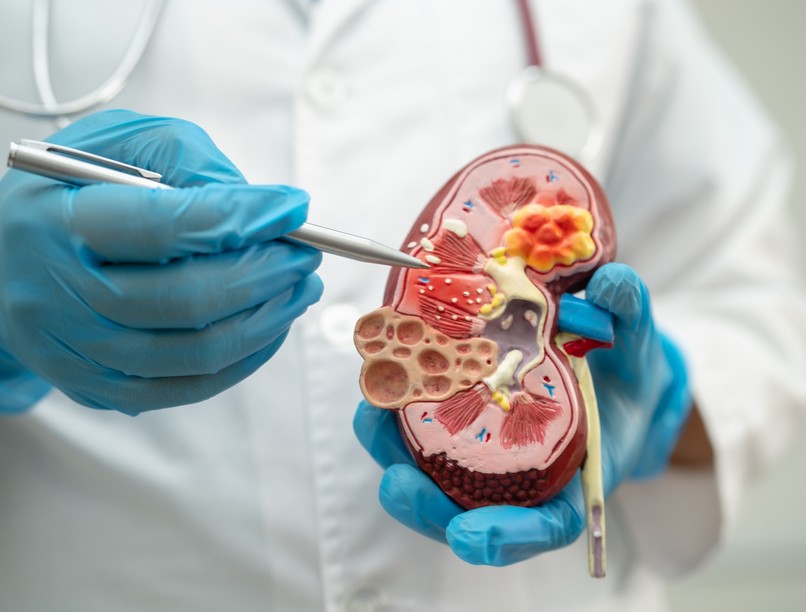 krónikus vesebetegség korai felismerése szövődmény