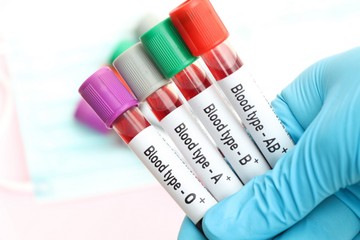 Korai stroke: a vércsoportunkon is múlhat, mekkora az esélyünk az agyvérzésre