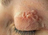 Bőrférgesség: hazánkban is támad a zoonózis!