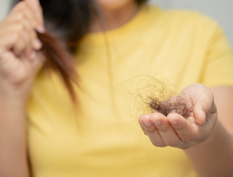 hajhullás, oka, pcos, hormonzavar