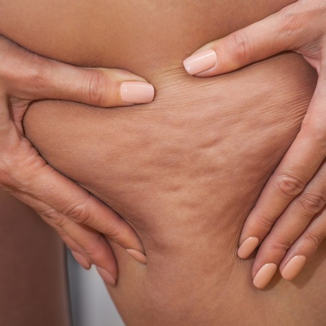 Lipödéma vagy cellulit? Sokan összekeverik, pedig nem ugyanaz című cikk nyitóképe